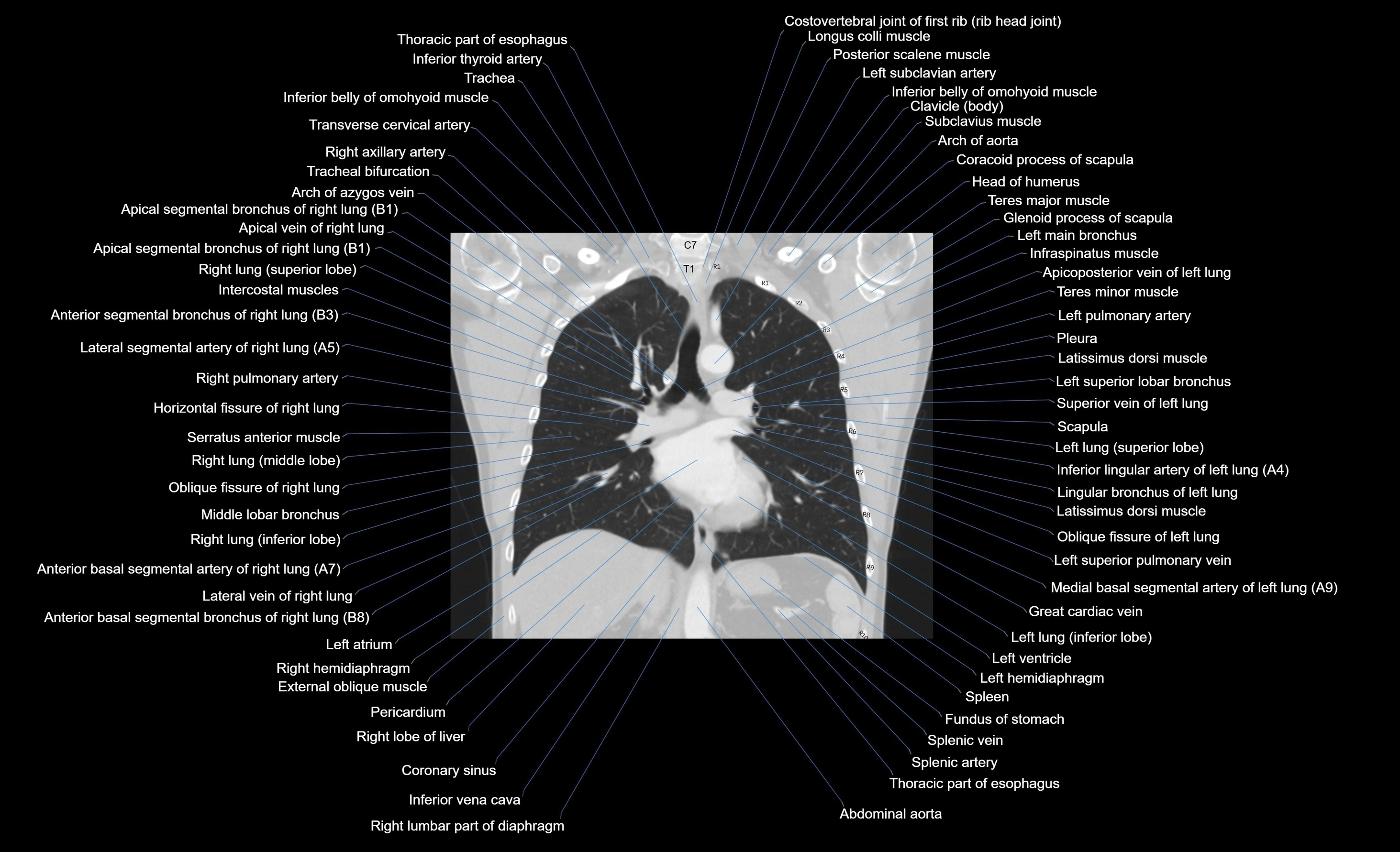 CT chest (thorax) lung window window labelled coronal cross sectional anatomy radiology image-00058.webp